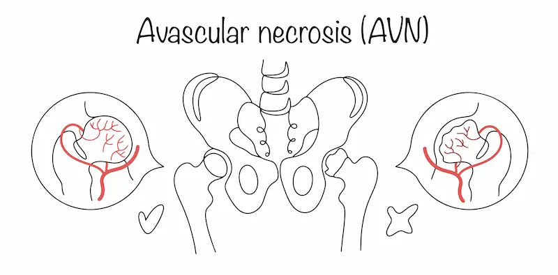 Avascular Necrosis: Causes & Treatment